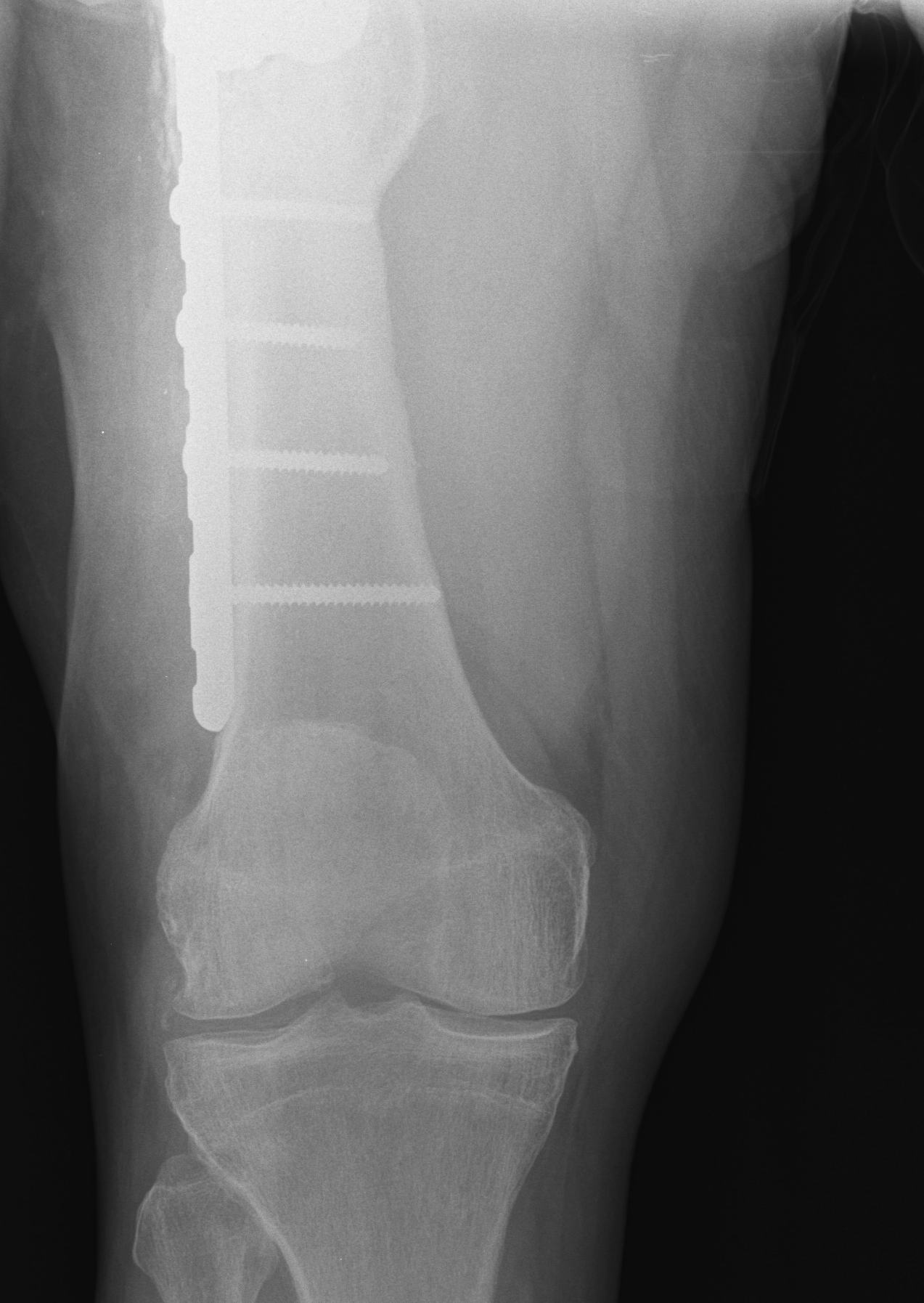 TKR Femoral Fracture